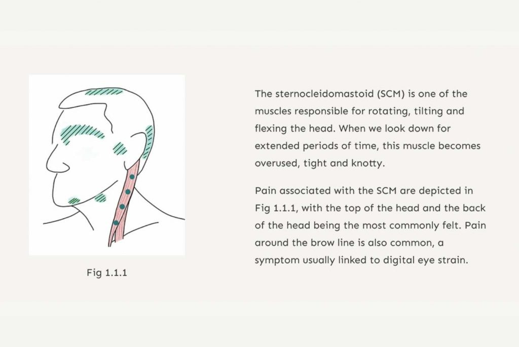 Illustration-of-sternocleidomastoid-muscle-pain